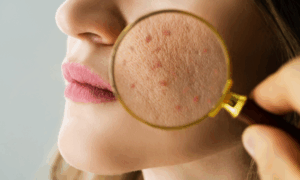 lymphatic drainage